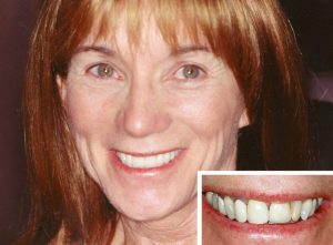 A La Costa Dental Excellence patient who recieved dental crowns.