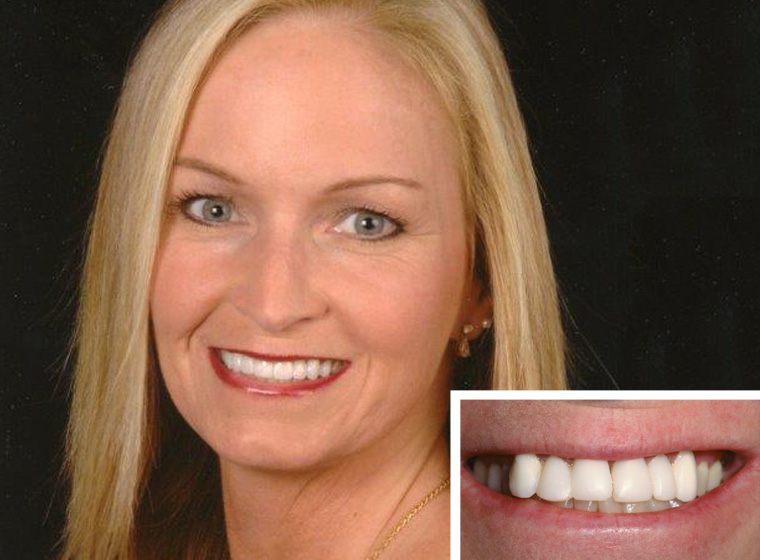 actual porcelain veneers patient results in Carlsbad, CA