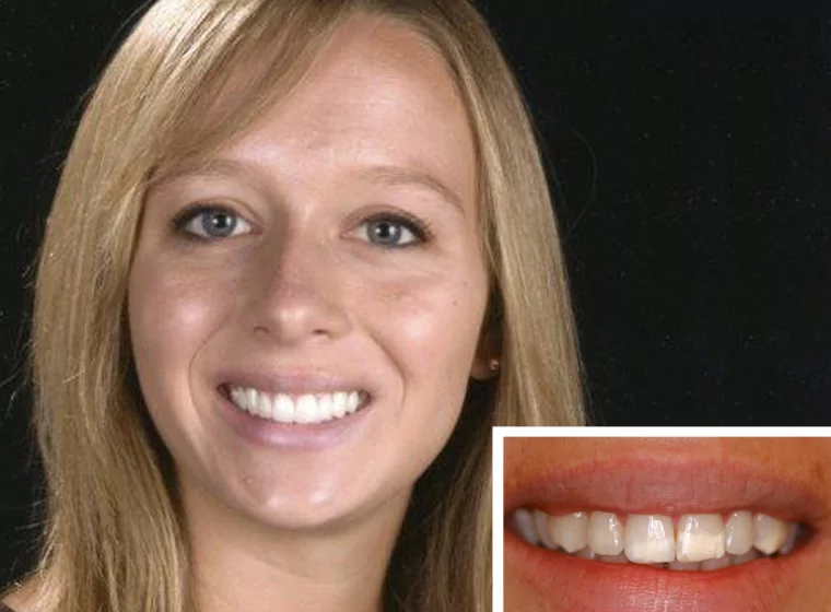 Porcelain veneers from Carlsbad Dentist Dr. Duckworth