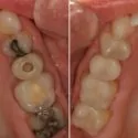 cerec-before-after-2