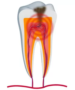 Close up photo of a tooth infection, a problem treatable by an emergency dentist.