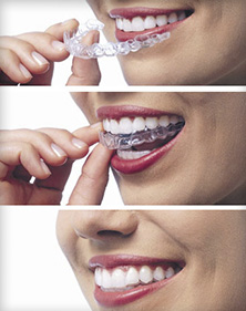 Invisalign straightens teeth for San Marcos, CA patients using clear aligners.