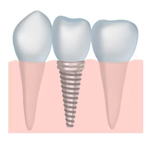 Carlsbad implant dentist Dr. Dankworth can answer your frequently asked questions about implant dentistry.