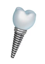 A dental implant in Carlsbad is the perfect solution to replace a missing tooth