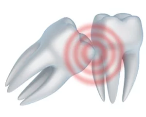 Sometimes wisdom teeth can cause problems for patients and thus it good to have a preventative wisdom teeth removal.