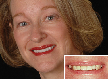 dental implants dentist for Carlsbad and San Marcos CA