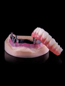 A model of implant supported dentures, lower teeth.