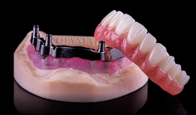 A model of implant supported dentures, lower teeth.