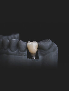 A graphic of a fixed dental implant.