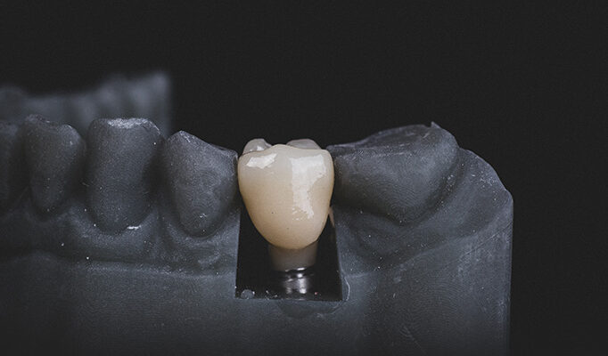 A graphic of a fixed dental implant.